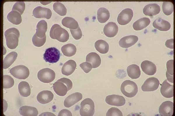 0137001-Lymphocyte-platelet-fragment-megathrombocyte-M-7-leukemia