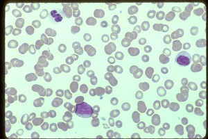 Pelgeroid neutrophil, lymphocyte, AML blood