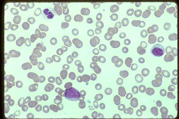 0137043-Pelgeroid-neutrophil-lymphocyte-AML-blood