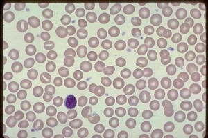 Normal Platelets , Normal EDTA anticoagulated blood