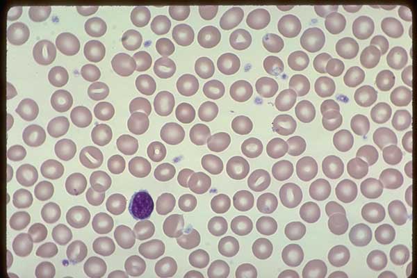 0144065-Normal-Platelets- Normal-EDTA-anticoagulated-blood