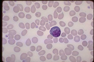 Plasma Cell, alcoholic, liver disease blood