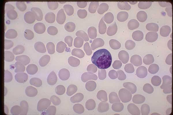 0147061-Plasma-Cell-alcoholic-liver-disease-blood