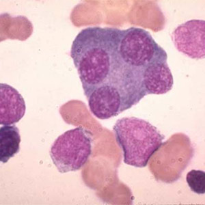 Leukemia