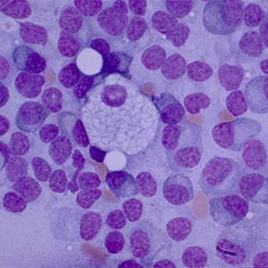 Multiple Myeloma